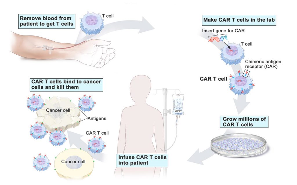 CAR T-cell Therapy