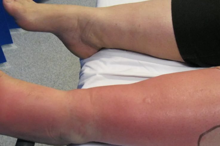 What’s cellulitis? A dermatologist explains