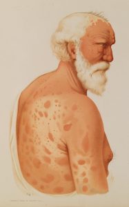 Illustration of a man with Leprosy.